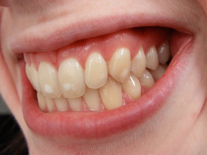 Почему появляются пятна на зубах?