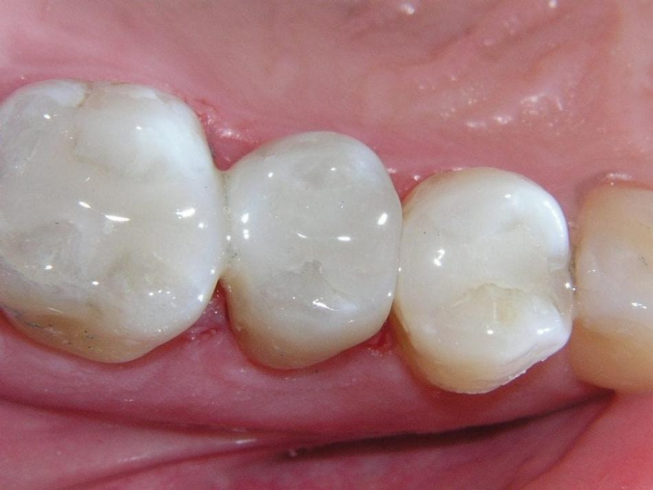 Сколько можно держать мышьяк в зубе?