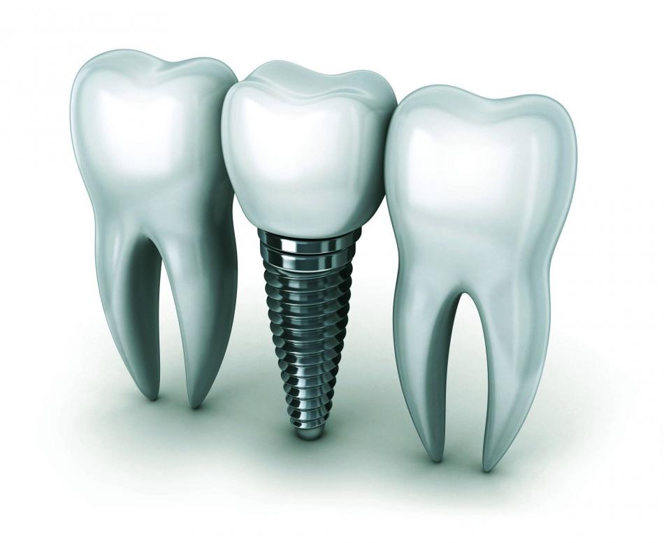 Какие импланты рекомендуют стоматологи?