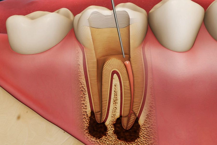 Сколько длится боль после лечения пульпита зуба?