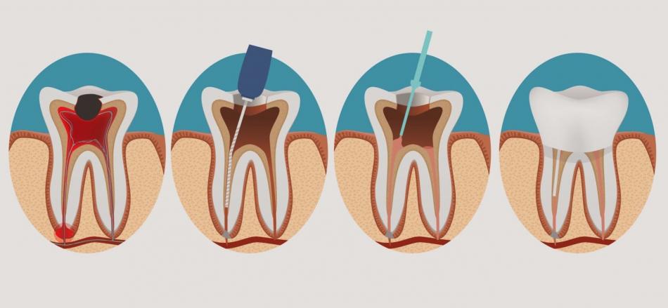 Больно ли лечить зуб при пульпите?